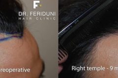 Haartransplantation Geheimratsecken Vorher Nachher 1500 Grafts Dr.  Feriduni- Hairforlife.ch