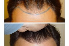 Haartransplantation Geheimratsecken Vorher Nachher 2000 Grafts Dr. Heitmann Hairforlife.ch