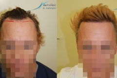 Haartransplantation Geheimratsecken Vorher Nachher 2400 Grafts Dr. Heitmann - Hairforlife.ch
