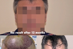 Haartransplantation Geheimratsecken Vorher Nachher HLC 2500 Grafts - Hairforlife.ch