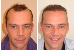 Haartransplantation Geheimratsecken Vorher Nachher 1600 Grafts Dr. Heitmann - Hairforlife.ch