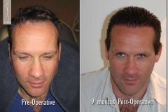 Haartransplantation Geheimratsecken Vorher Nachher 2860 Grafts Dr. Feriduni - Hairforlife.ch