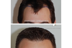 Haartransplantation Geheimratsecken Vorher Nachher 800 Grafts Dr. Feriduni - Hairforlife.ch