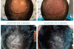 Haartransplantation Tonsur Vorher Nachher Dr.  Michalis3058 Grafts - Hairforlife.ch