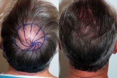 Haartransplantation Tonsur Vorher Nachher Dr. Feriduni 2354 Grafts - Hairforlife.ch