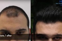 Haartransplantation Vorher Nachher Türkei HLC 3600 Grafts - Hairforlife.ch Galerie
