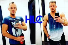 Haartransplantation Vorher Nachher Geheimratsecken HLC 2333 Grafts - Hairforlife.ch