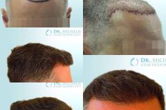 Haartransplantation Vorher Nachher 2979 Grafts Dr. Michalis - Hairforlife.ch Galerie