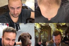 Haartransplantation Vorher Nachher Türkei HLC - Hairforlife.ch
