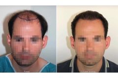 Haartransplantation Vorher Nachher Glatze Dr. Feriduni - Hairforlife.ch