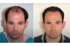Haartransplantation Vorher Nachher Glatze Dr. Feriduni - Hairforlife.ch