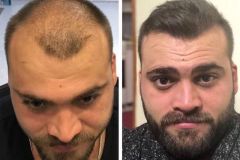 Haartransplantation Vorher Nachher Türkei HLC - Hairforlife.ch Galerie