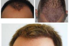Haartransplantation Vorher Nachher 3500 Grafts Dr. Mwamba - Hairforlife.ch Galerie