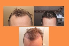 Haartransplantation Geheimratsecken Vorher Nachher Dr. Mwamba 1986 Grafts - Hairforlife.ch Galerie