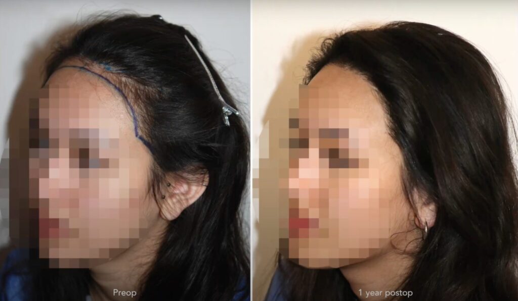 Haartransplantation Frauen Vorher Nachher Geheimratsecken hohe Stirn - Hairforlife.ch