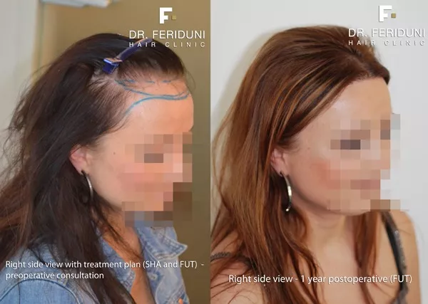Haartransplantation Frauen Vorher Nachher hohe Stirn Geheimratsecken Beispiel 2 - Hairforlife.ch