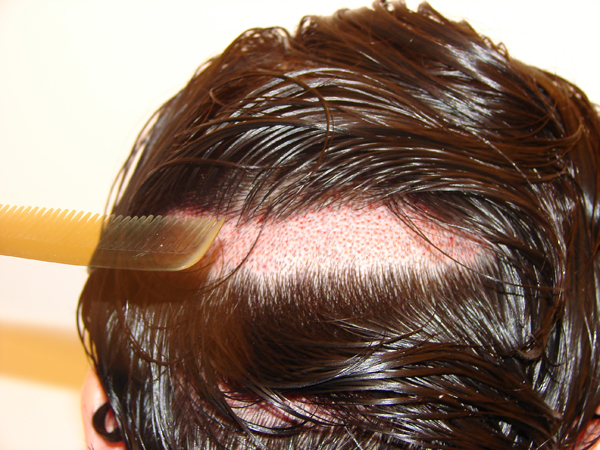 Haartransplantation FUE Streifenrasur am Hinterkopf im Spenderbereich Hairforlife.ch