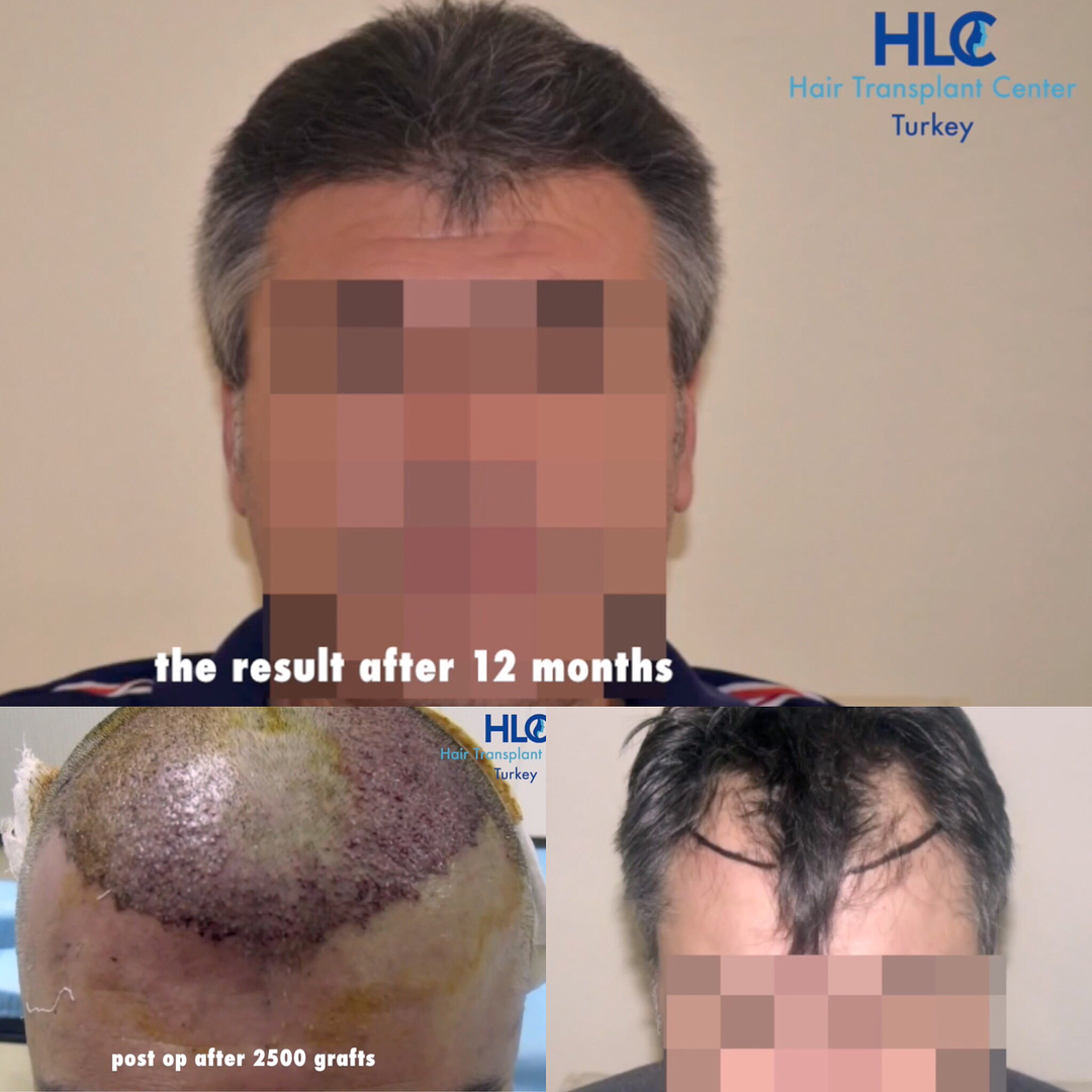 Haartransplantation Türkei Vorher Nachher 2 Hairforlife.ch