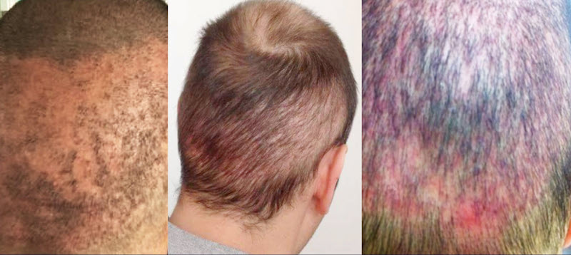 Risiken einer Haartransplantation: Dezimierter Haarkranz nach Billig-FUE 