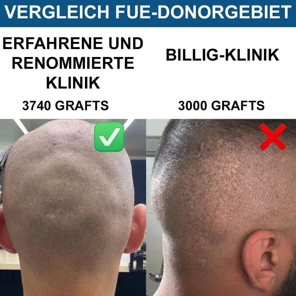 Hairforlife.ch FUE Haartransplantation Vergleich Low Cost Anbieter vs. erfahrene Klinik - Bild 2