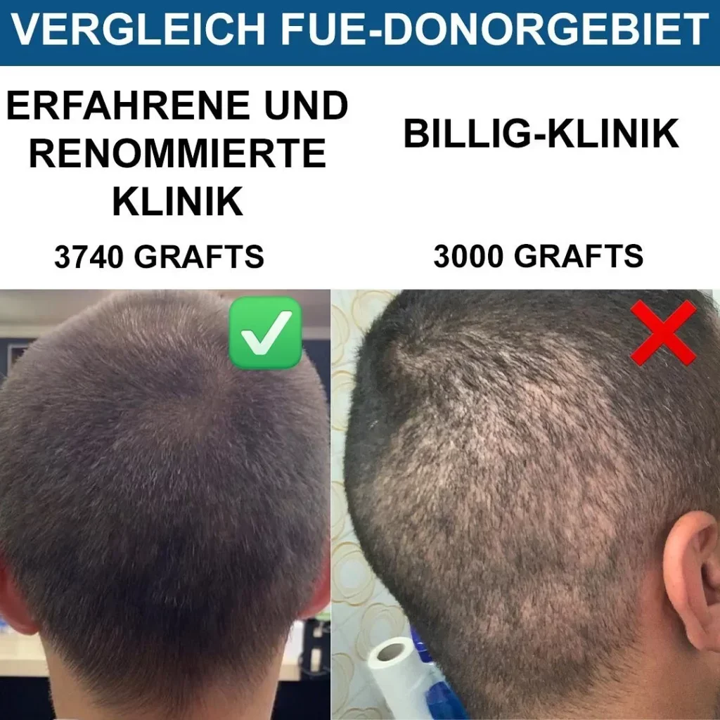 Hairforlife.ch FUE Haarverpflanzung Vergleich höhere Risiken Low Cost Anbieter vs. erfahrene Klinik
