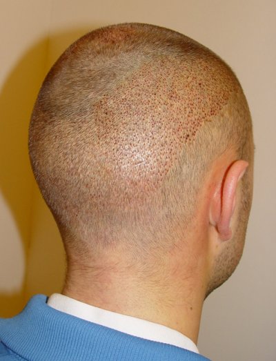 Vollrasur bei einer FUE Haartransplantation