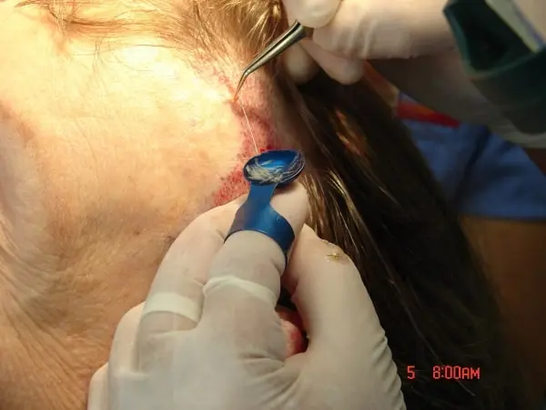 Das Einsetzen der Transplantate bei einer Haartransplantation mit Pinzette