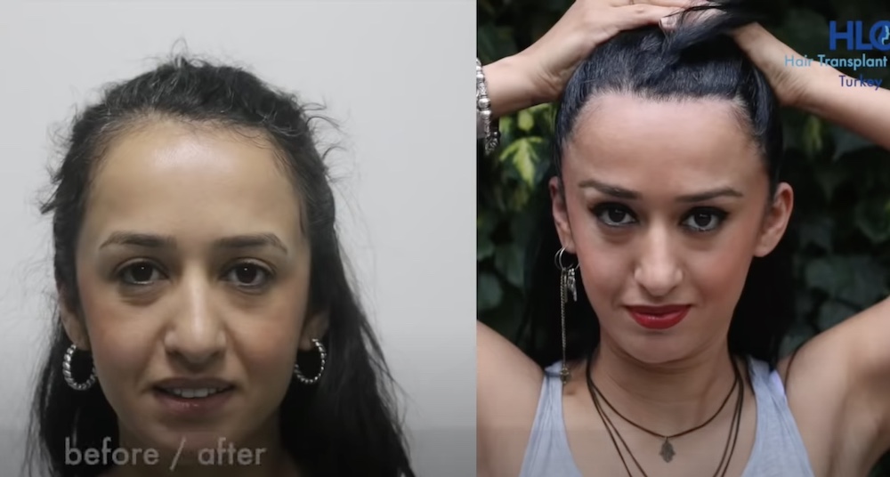 Haartransplantation Frauen Geheimratsecken Vorher Nachher Hairforlife.ch