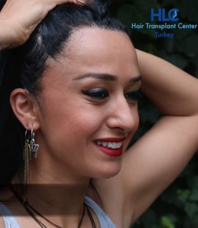 Haartransplantation Frauen Hairforlife Schweiz