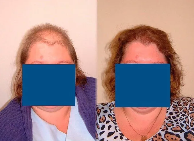 Haartransplantation Frauen Vorher Nachher Hairforlife.ch Beispiel 3