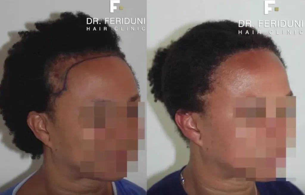 Haartransplantation Frauen Vorher Nachher Beispiel 4 Hairforlife.ch