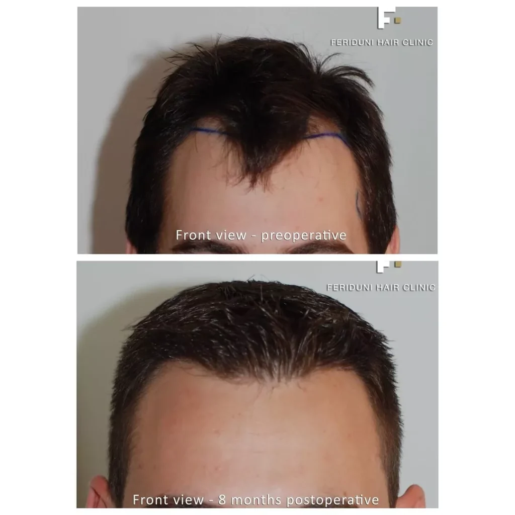 Haartransplantation Geheimratsecken Vorher Nachher Beispiel 1 Hairforlife.ch