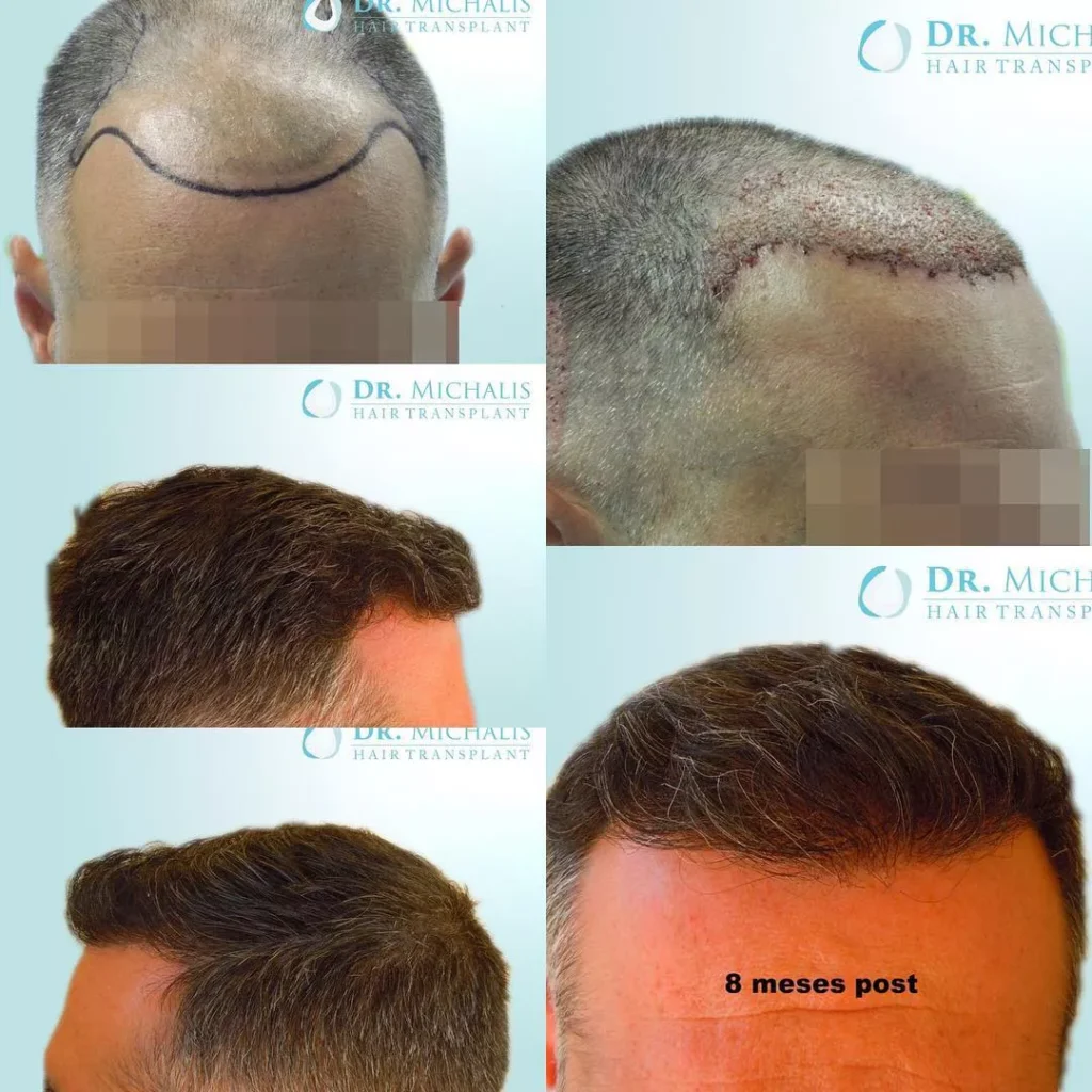 Haartransplantation Geheimratsecken Vorher Nachher Beispiel 3 Hairforlife.ch