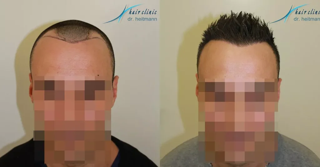 Haartransplantation Geheimratsecken Vorher Nachher - 4 Hairforlife.ch