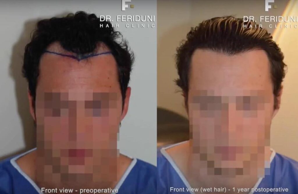 Haartransplantation Geheimratsecken Vorher Nachher -Beispiel  6 Hairforlife.ch