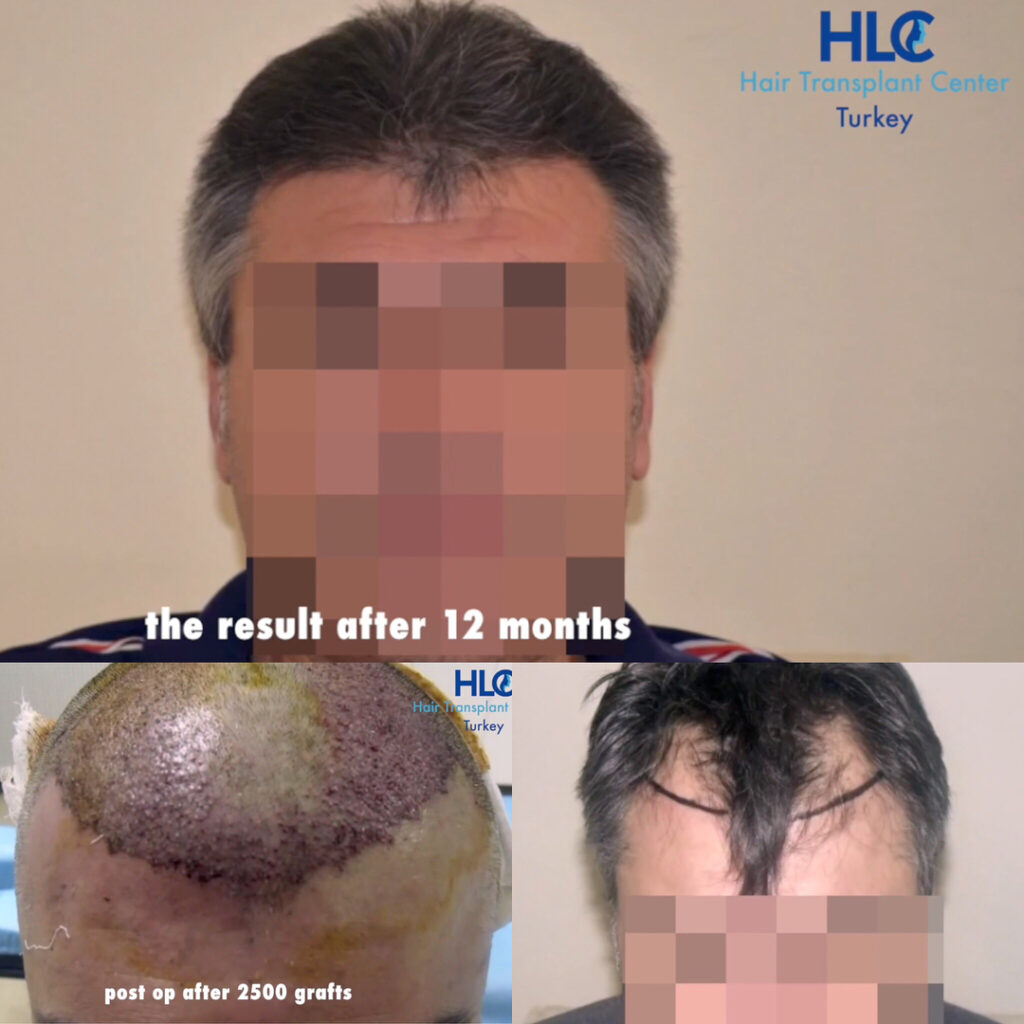 Haartransplantation Geheimratsecken Vorher Nachher -Beispiel 7 - HLC- Hairforlife.ch