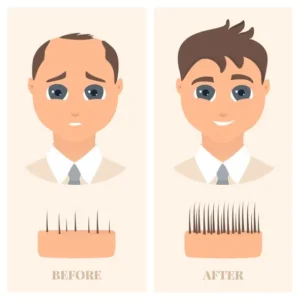 Haartransplantation Informationen Hairforlife.ch