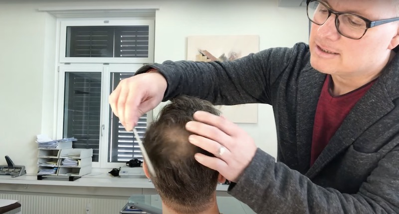 Joachim`s Fortschreitender Haarausfall in der Tonsur: Ist eine weitere Haartransplantation bereits sinnvoll?