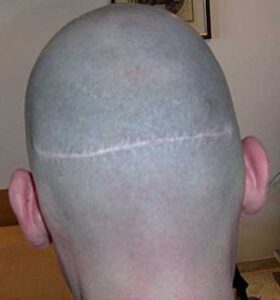 Haartransplantation Beispielnarbe nach einer FUT-Streifenhaarverpflanzung