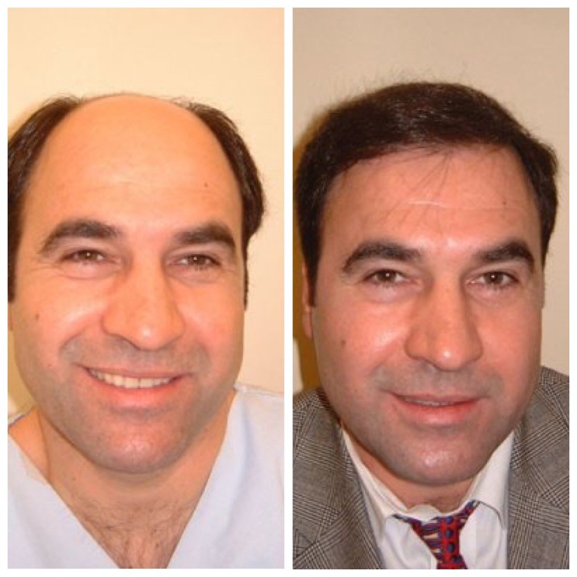 Haartransplantation bei Glatze Beispiel