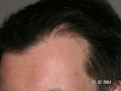 Negative Erfahrung linke Seite nach Haarverpflanzung mit DHI Methode Rötung
