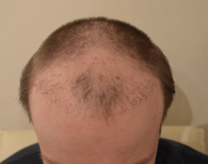 Beispiel Resultat verpfuschte misslungene Haartransplantation Hairforlife.ch