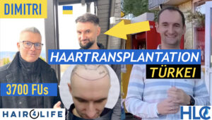 FUE Haartransplantation Türkei Erfahrungsbericht Vorher Nachher Resultat Vorder Glatze