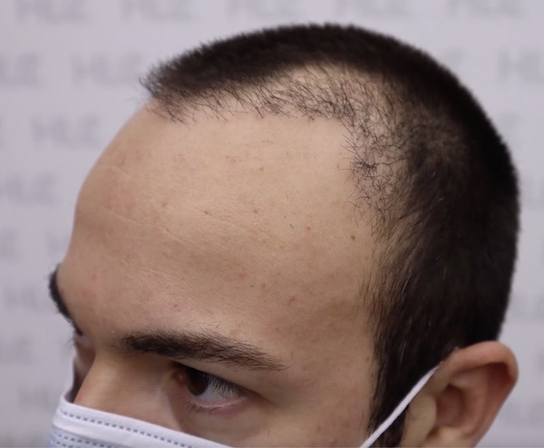 Haartransplantation Türkei Istanbul misslungene OP: Beispiel fehlgestaltete Haarlinie, geringe Anwuchsrate, falsche Wuchsrichtung