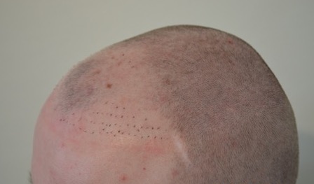 Haartransplantation Korrektur Reparatur - Hairforlife.ch