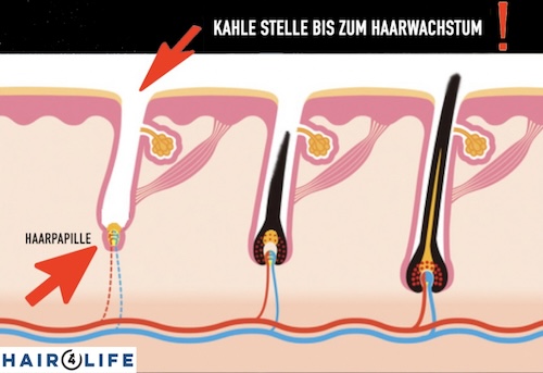 Bis das Wachstum nach der OP beginnt, ist die Implantatsstelle leer - Hairforlife.ch