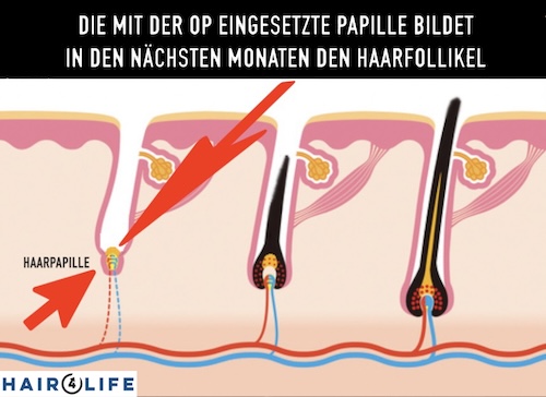 Anwachsen der Transplantate nach der Haartransplantation: Verantwortlich für das Wachstum ist die Haarpapille - Hairforlife.ch