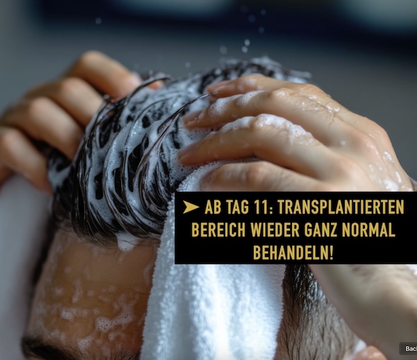 11 Tage nach der Haartransplantation können die Haare wieder normal gewaschen werden