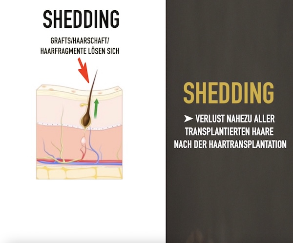 Der Prozess Shedding im Anschluss an eine Haartransplantation ist normal