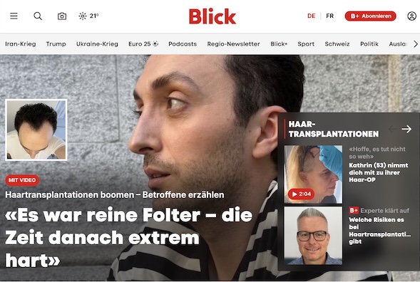 Andreas Krämer von Hairforlife.ch - Interview zu Haartransplantation vom Blick in Print sowie online